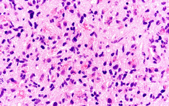 3A7 Glioblastoma, granular cell type (Case 3) FS 60X