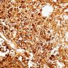 3B1 Glioblastoma, granular cell type (Case 3) GFAP 2.jpg