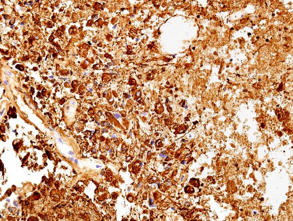 3B1 Glioblastoma, granular cell type (Case 3) GFAP 2.jpg