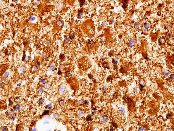 3B3 Glioblastoma, granular cell type (Case 3) GFAP 4.jpg