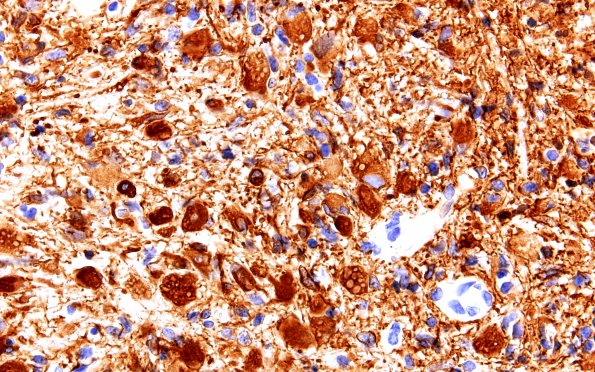 3B4 Glioblastoma, granular cell type (Case 3) GFAP 60X