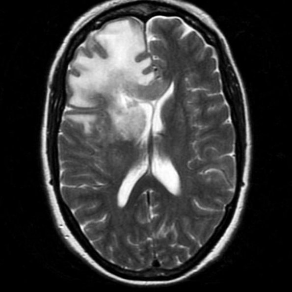 4A1 GBM, granular cell (Case 4) MRI 4 - Copy