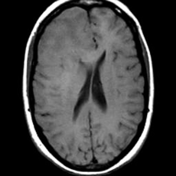 4A2 GBM, granular cell (Case 4) MRI 8 - Copy