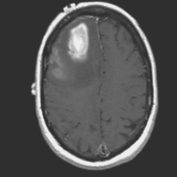 4A3 GBM, granular cell (Case 4) MRI 1 - Copy