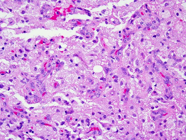 4B4 GBM, granular cell (Case 4) 6.jpg