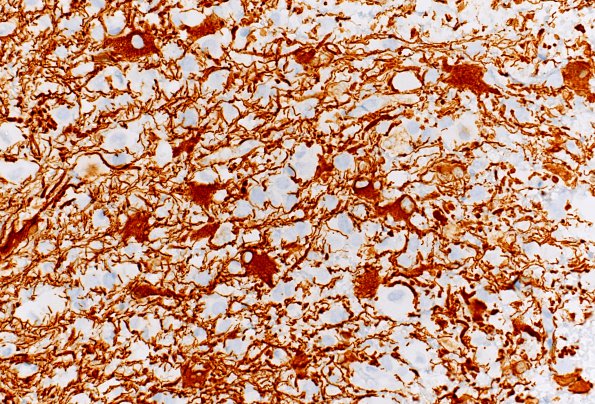 4C GBM, granular cell (Case 4) GFAP 40X