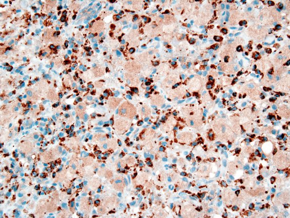 4D1 GBM, granular cell (Case 4) CD68 1.jpg