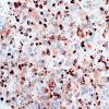 4D2 GBM, granular cell (Case 4) CD68 2.jpg