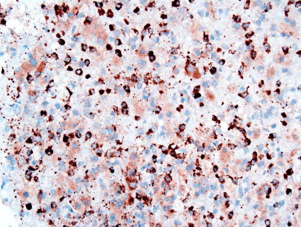 4D2 GBM, granular cell (Case 4) CD68 2.jpg