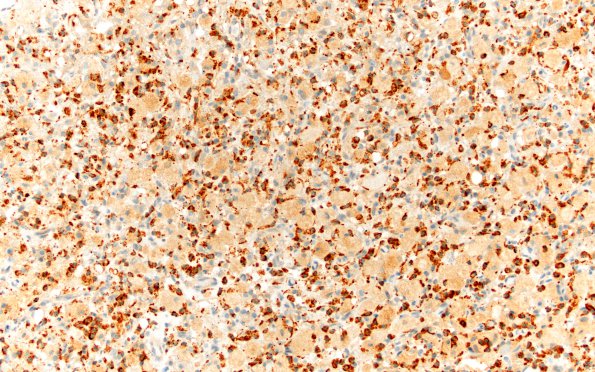 4D3 GBM, granular cell (Case 4) CD68 20X