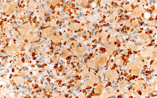 4D4 GBM, granular cell (Case 4) CD68 40X