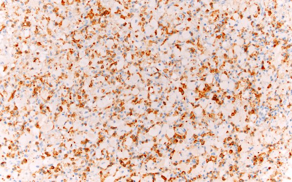 4E GBM, granular cell (Case 4) CD163 20X A