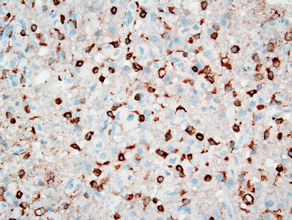 4E GBM, granular cell (Case 4) CD163 2.jpg
