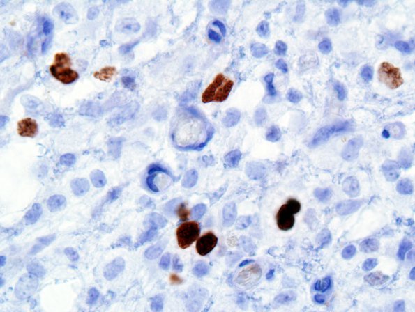 4G GBM, granular cell (Case 4) Ki-67 2.jpg