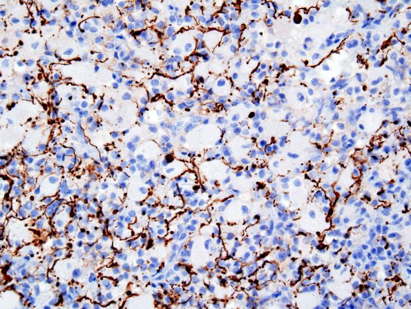 4H1 GBM, granular cell (Case 4) NFP 1.jpg