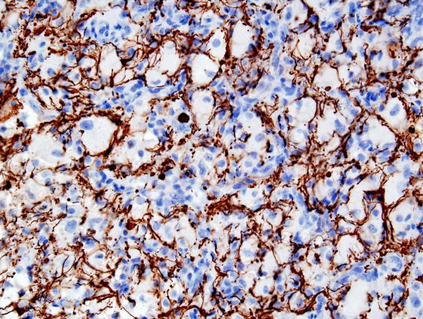 4H2 GBM, granular cell (Case 4) NFP 2.jpg