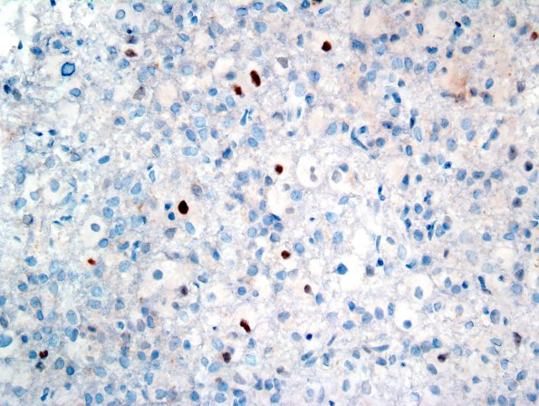 4J GBM, granular cell (Case 4) p53.jpg