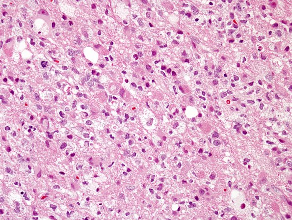 5A1 Glioblastoma, with Granular cells (Case 5) H&E 1