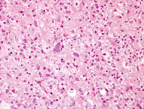 5A2 Glioblastoma, with Granular cells (Case 5) H&E 2