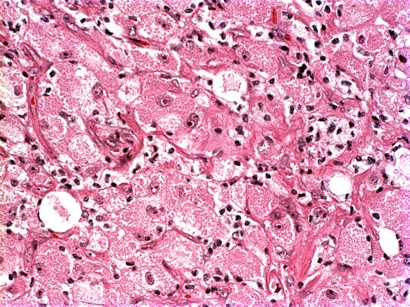 5A3 Glioblastoma, with Granular cells (Case 5) H&E 3