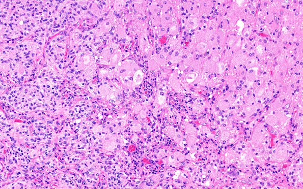 6A1 GBM, Granular Cell (Case 6) H&E 1