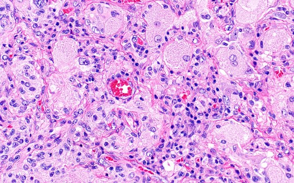 6A2 GBM, Granular Cell (Case 6) H&E 2