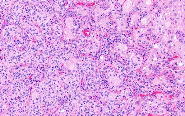 6A3 GBM, Granular Cell (Case 6) H&E 3