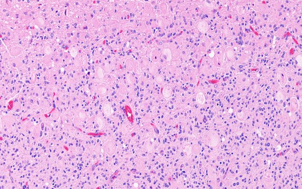 6A4 GBM, Granular Cell (Case 6) H&E 4
