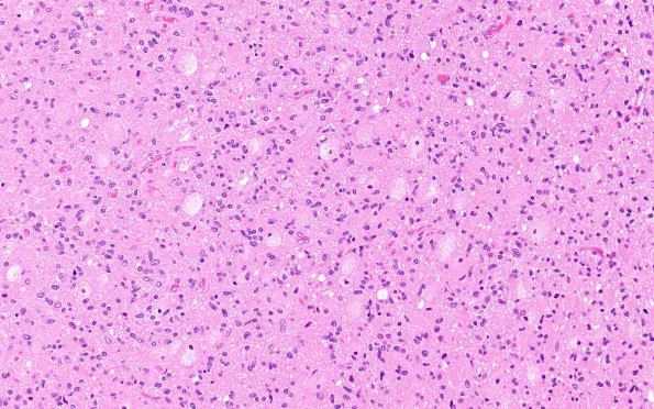 6A6 GBM, Granular Cell (Case 6) H&E 6