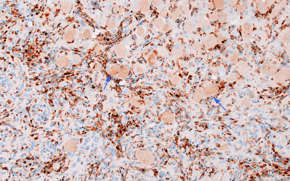 6C1 GBM, Granular Cell (Case 6) CD68 2 copy