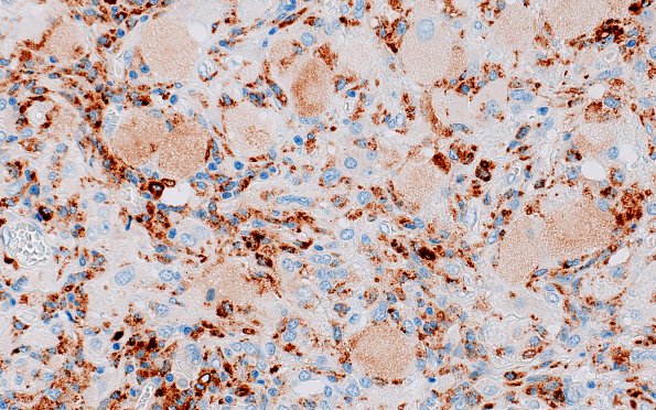 6C2 GBM, Granular Cell (Case 6) CD68 1