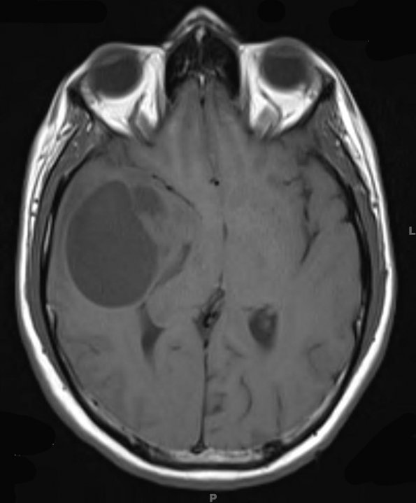 7A1 GBM (Case 7) T1 - Copy