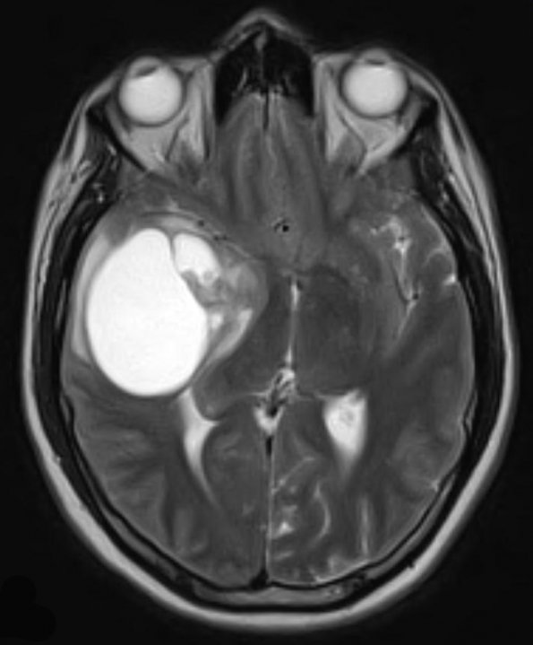 7A3 GBM (Case 7) T2 - Copy