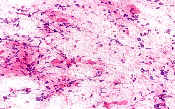 7B1 Glioblastoma, granular cell type (Case 7) TP 20X