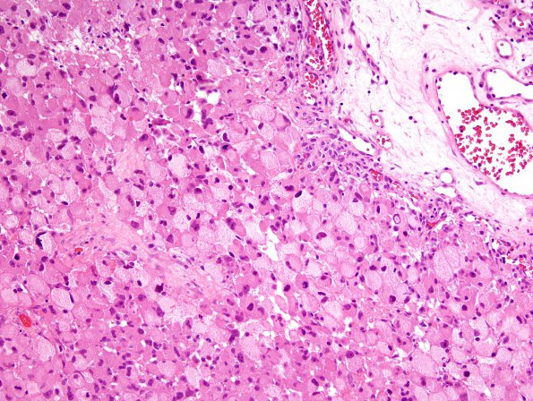 7B2 GBM (Case 7) H&E 2