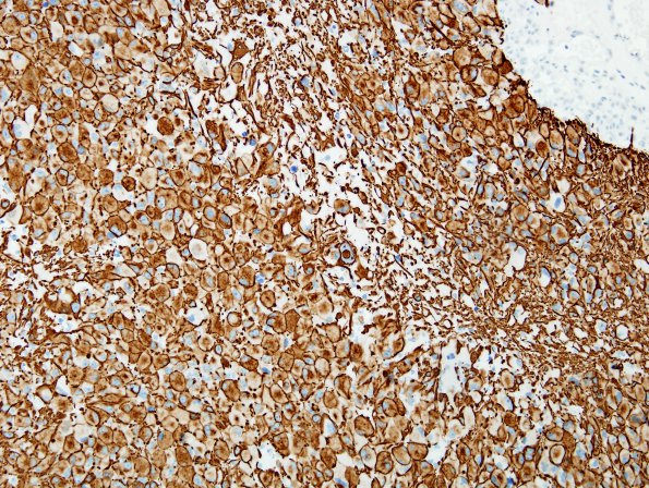 7C1 GBM (Case 7) GFAP 3