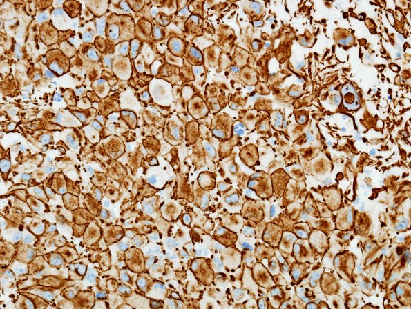 7C2 GBM (Case 7) GFAP 2