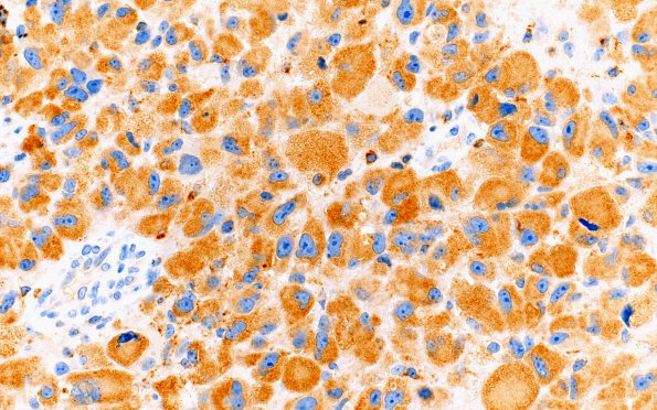 7D GBM (Case 7) CD68 40X 1