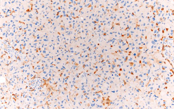 7E1 GBM (Case 7) CD163 20X 1