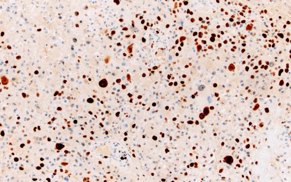 7F GBM (Case 7) Ki67 40X 1