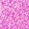 8B4 Granular Cell GBM (Case 8) H&E B9 40X 2