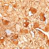 8C4 Granular Cell GBM (Case 8) GFAP 60X