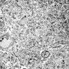8I4 Granular Cell GBM (Case 8) EM 004 - Copy