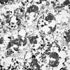 8I6 Granular Cell GBM (Case 8) EM 007 - Copy