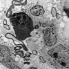 10A3 Glioblastoma (Case 10A3) EM - Copy