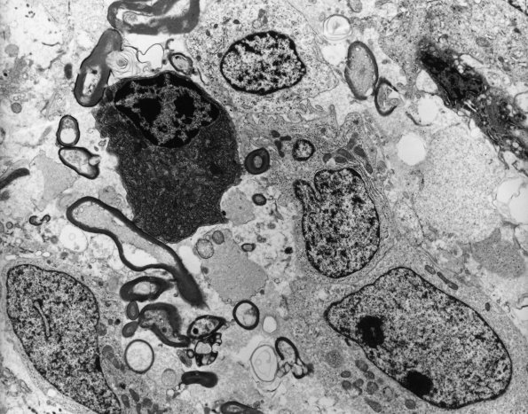 10A3 Glioblastoma (Case 10A3) EM - Copy