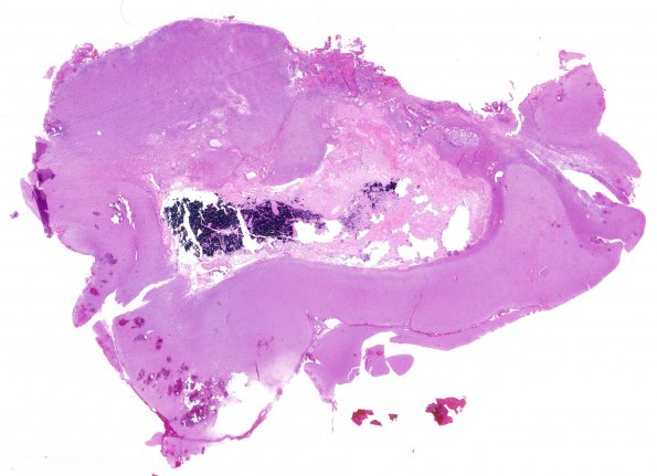 11A1  GBM & Radiation (Case 11A) H&E WM