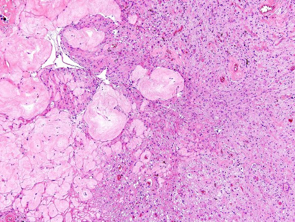 11A4 GBM & Radiation (Case 11A) H&E 4.jpg