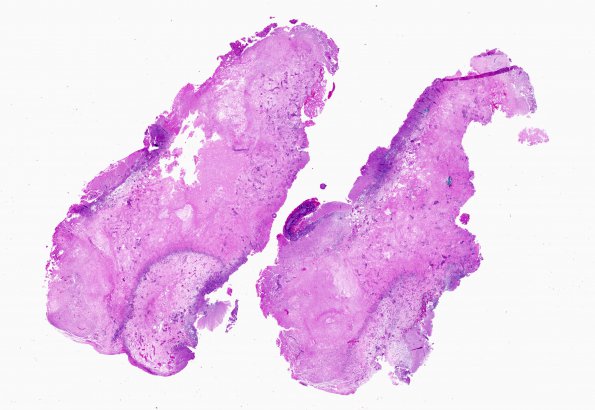 11B1 GBM with Radiation Necrosis (Case 11B) H&E WM