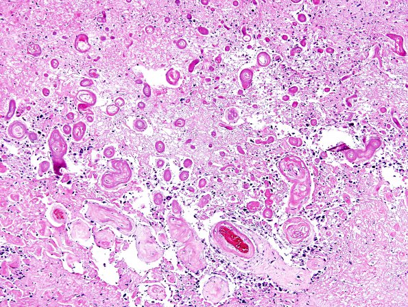 11B2 GBM with Radiation Necrosis (Case 11B) H&E 4